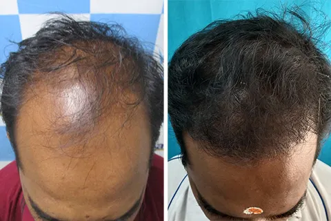 Hair rejuvation therapy before photo in VCare